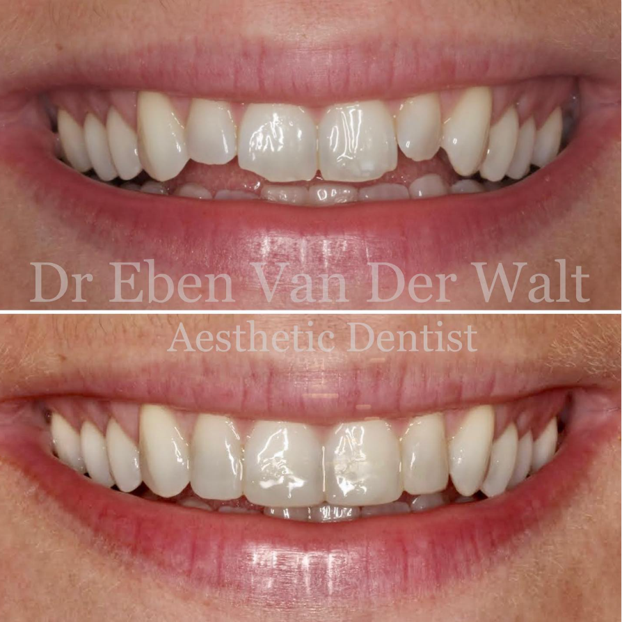Before and after — Alignment & Whitening