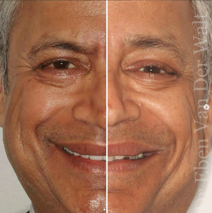 Before and after — Full Smile Restoration