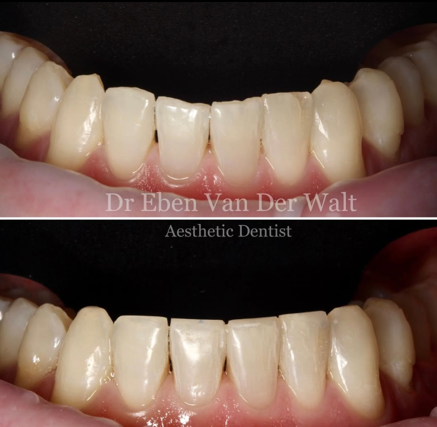 Before and after — Lower Arch Refinement