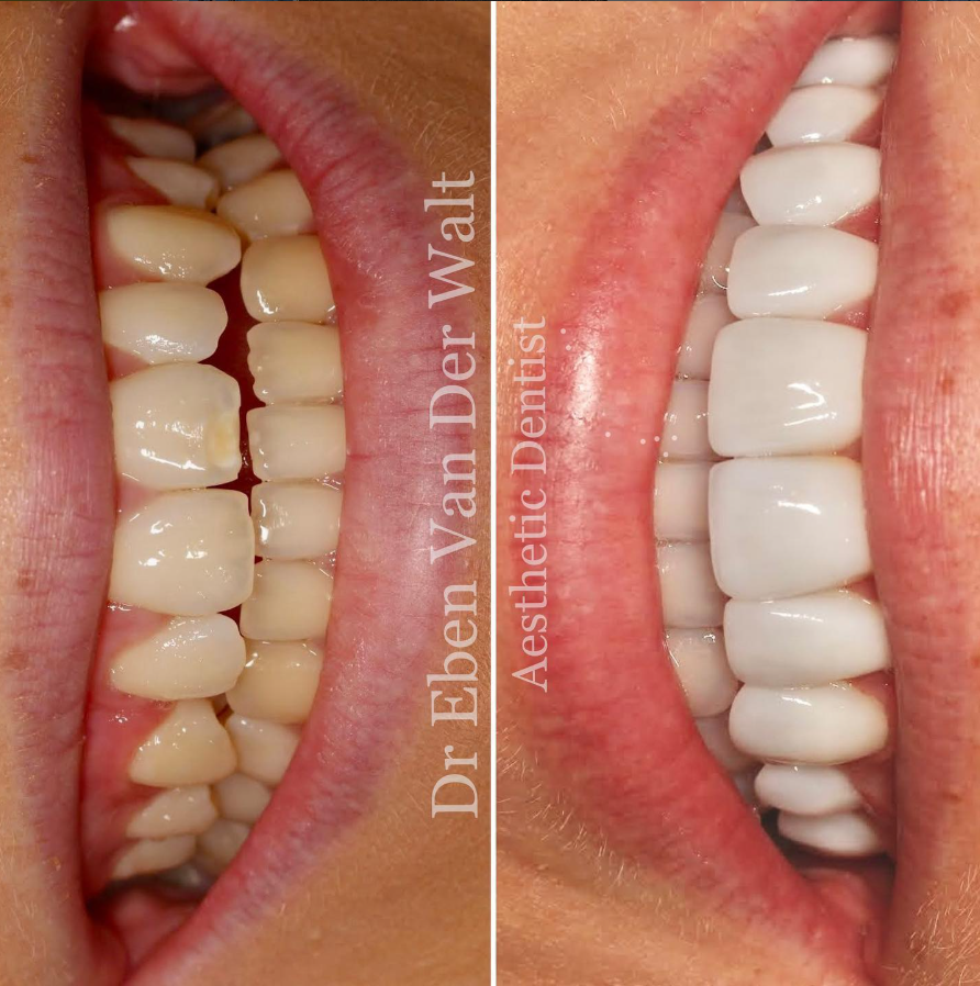 Before and after — Veneers & Bonding
