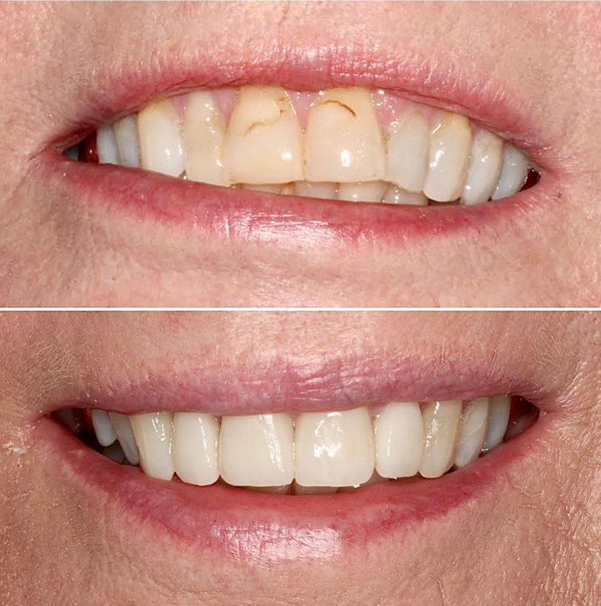 Before and after — Upper Teeth Restoration
