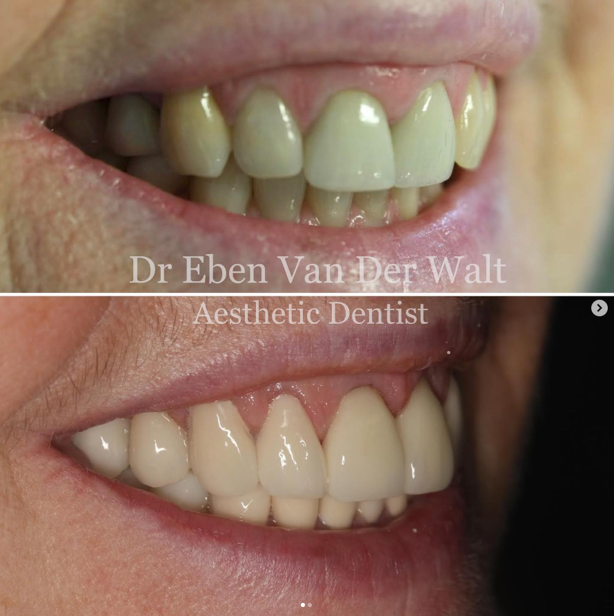 Before and after — Crown & Veneer Placement