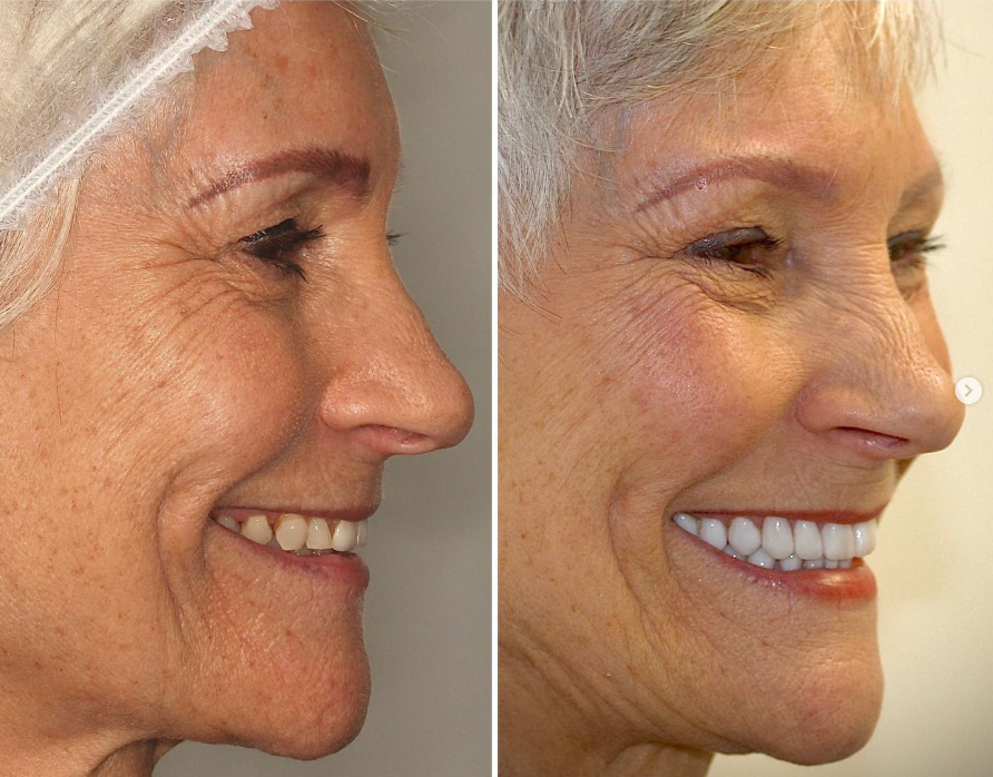 Before and after — Smile Transformation